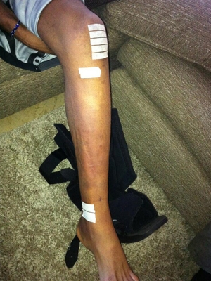 Perna de Anderson Silva, com bandagens Perna de Anderson Silva, com bandagens